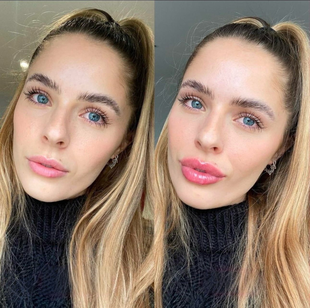 UGC vorher vs nachher